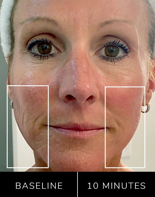 Before and after comparison of a woman's face with visible skin texture changes over 10 minutes.