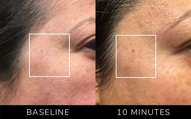 Before and after comparison of skin texture with baseline and 10 minutes.