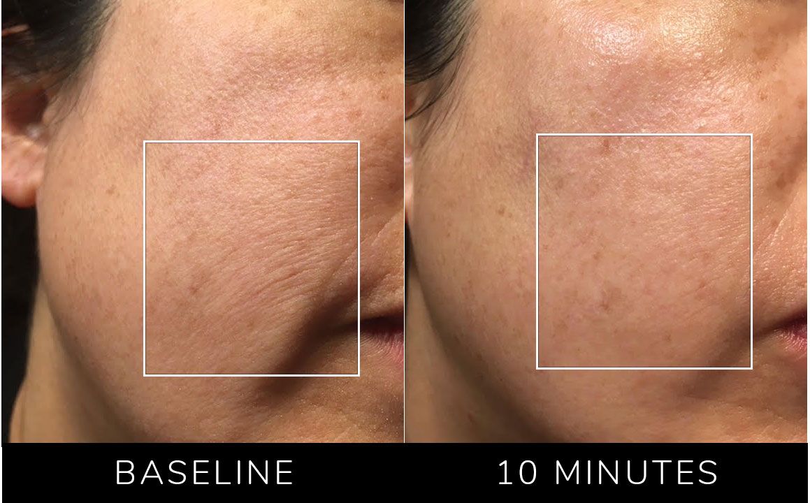 Before and after comparison of skin texture on a person's face, labeled 'Baseline' and '10 Minutes'.